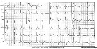 Case Report: Takotsubo Syndrome Associated With Novel Coronavirus Disease 2019